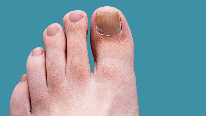 Hoe teennagel en voetschimmel voorkomen en behandelen