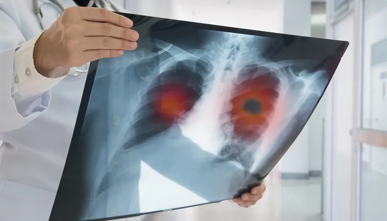 Longkanker, de “dubbelganger” met “intelligente” medicijnen voor vormen met de KRAS G12C-mutatie