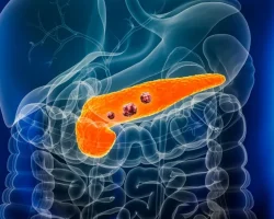 Alvleesklierkanker, hoe het resistent wordt tegen medicijnen. De ontdekking van de onderzoekers en waarom het ertoe doet