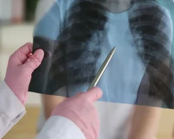 Tuberculosealarm in Triëst, 30 studenten positief. De geruststellingen van de experts, risico’s en vaccinatie