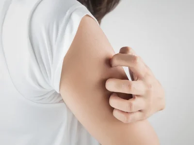 Chronische jeuk, als het om Prurigo Nodularis gaat, hoe herken je het en hoe ga je ermee om?