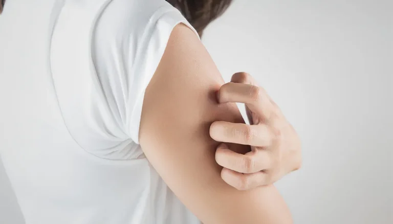 Chronische jeuk, als het om Prurigo Nodularis gaat, hoe herken je het en hoe ga je ermee om?