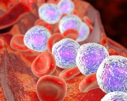 Acute lymfatische leukemie: wat het is, wie erdoor wordt getroffen en hoe het moet worden behandeld