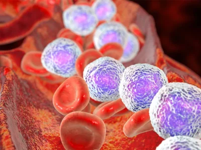 Acute lymfatische leukemie: wat het is, wie erdoor wordt getroffen en hoe het moet worden behandeld