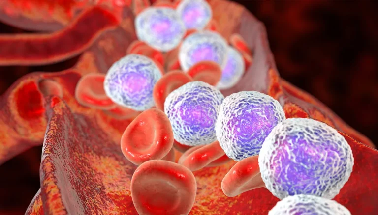 Acute lymfatische leukemie: wat het is, wie erdoor wordt getroffen en hoe het moet worden behandeld
