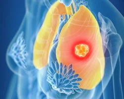 Microcytoom, waarom het zo moeilijk is om om te gaan met de tumor waar Emma Bonino aan leed
