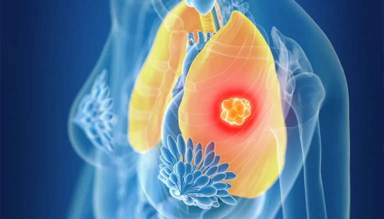 Microcytoom, waarom het zo moeilijk is om om te gaan met de tumor waar Emma Bonino aan leed