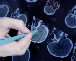 Epilepsie, een nieuw alternatief voor medicijnresistente vormen: wat epicraniale stimulatie is en hoe het werkt