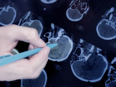 Epilepsie, een nieuw alternatief voor medicijnresistente vormen: wat epicraniale stimulatie is en hoe het werkt