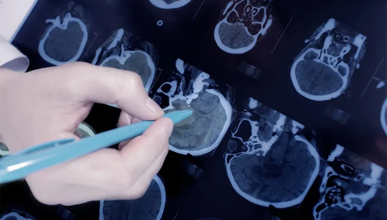 Epilepsie, een nieuw alternatief voor medicijnresistente vormen: wat epicraniale stimulatie is en hoe het werkt