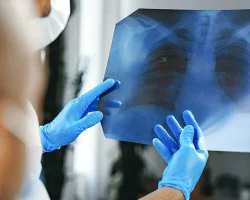 Longkanker, bij microcytoom “dubbele” immunotherapie verlengt de overleving in uitgebreide vormen