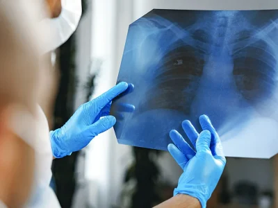 Longkanker, bij microcytoom “dubbele” immunotherapie verlengt de overleving in uitgebreide vormen