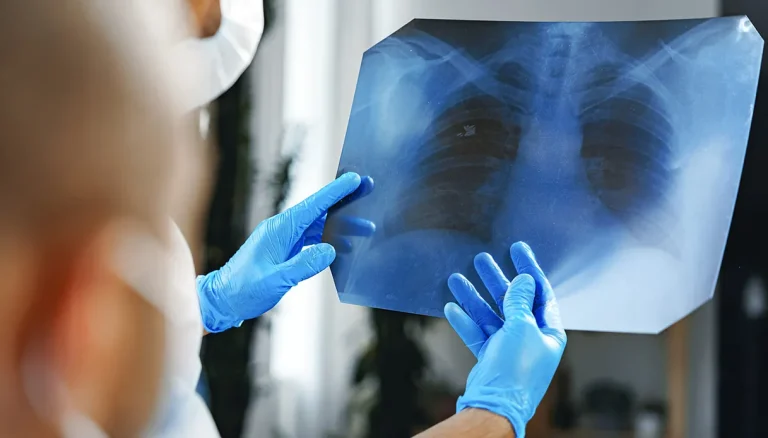 Longkanker, bij microcytoom “dubbele” immunotherapie verlengt de overleving in uitgebreide vormen